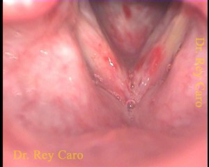 Post resección de fibrina de comisura anterior. After fibrin resection of the anterior commissure