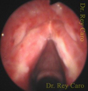 14 días post cirugía. 14 days post surgery