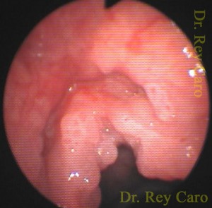 Papilomatosis que compromete cuerdas vocales y áreas ocultas como ventrículos. Papillomatosis of ventricle, and true and false vocal cords.