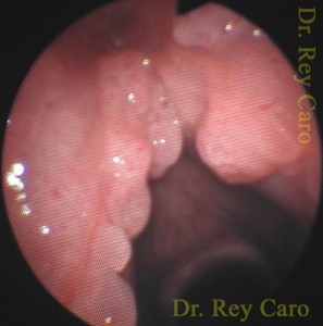 Papilomatosis agresiva de ambas cuerdas vocales, comisura anterior, supraglotis y subglotis. Agressive papillomatosis of glottic, subglottis and supraglottis