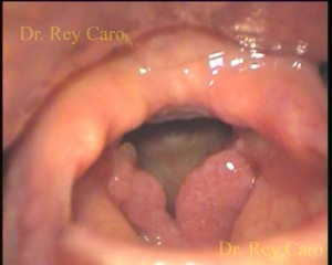 Papilomatosis y reflujo gastroesofágico severo en paciente con hernia de hiato. Severe reflux disease in a patient with papillomatosis