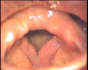 Papilomatosis severa de ambas cuerdas vocales y comisura anterior. Severe papillomatosis of vocal cords and anterior commissure