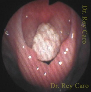 Papilomatosis obstructiva. El papiloma está pediculado de cuerda vocal derecha. Obstructive pediculated papilloma from right vocal cord