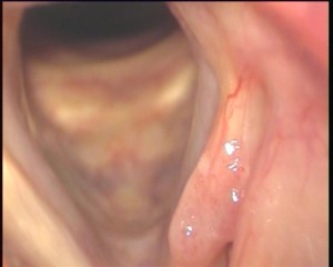 HPV infection. Close view of the left vocal cord