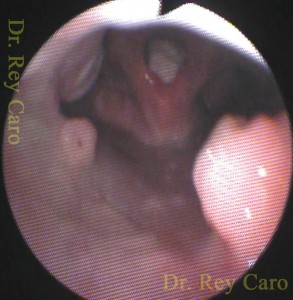 Papilomas de pared posterior de faringe y laringe. Pharyngeal and laryngeal papillomatosis in a 5 years old child