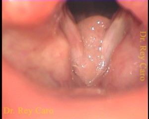 Papilomatosis de ambas cuerdas vocales y comisura anterior. Papillomatosis of both vocal cords and anterior commisure