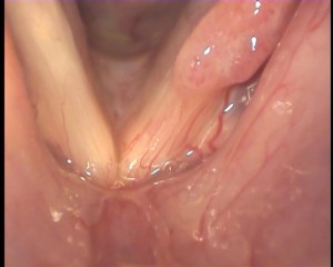 Closer view of left vocal cord papillomatosis 