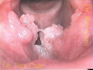 Papilomatosis vegetante de cuerdas vocales, ventriculos y supraglotis. Vegetant papillomatosis of vocal cord and ventricules