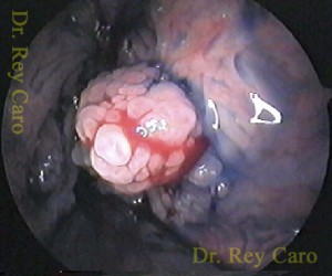 Cromoendoscopía intraoperatoria. Intraoperative chromoendoscopy of the papillomavirus infection