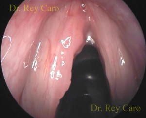 Imagen intraoperatoria con telescopio de 0°. Papilomatosis de cuerda vocal izquierda. Intraoperative image of left vocal cord papillomatosis