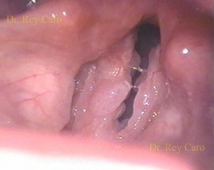 Puede observarse la afección de los ventrículos. In this view is possible to detect papillomas of the right ventricle