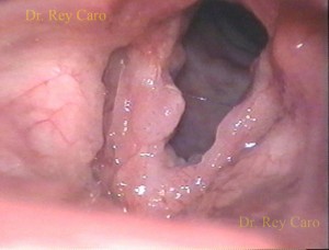 Papilomatosis de ambas cuerdas vocales, supraglotis y comisura anterior