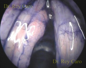 Cromoendoscopía intraoperatoria. Intraoperative chromoendoscopy