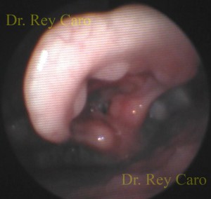 Papilomatosis de cara laríngea de epiglotis. Papillomatosis of the laryngeal surface of the epiglottis.