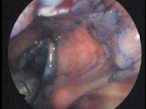 Cromoendoscopía de la región supraglótica y glótica. Chromoendoscopy of the glottic and supraglottic papillomatosis