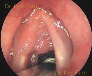 Papilomatosis de ambas cuerdas vocales, comisura anterior, aritenoides y epiglotis. 