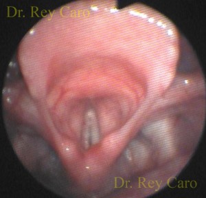 Resolución completa de la papilomatosis de epiglotis. Complete resolution of epiglottic papillomatosis