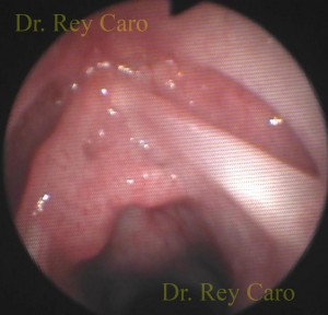 Visión cercana del compromiso de comisura anterior y subglotis. Anterior commissure and subglottis papillomatosis.