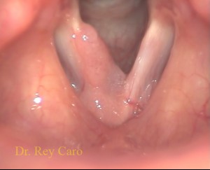 Papilomatosis de cuerda vocal derecha y comisura anterior. Right vocal cord and anterior commissure papillomatosis