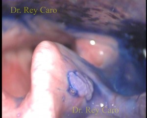 Cromoendoscopia muestra claramente una verruga en cara lingual de epiglotis. HPV villi view with chromoendoscpy in the epiglottis