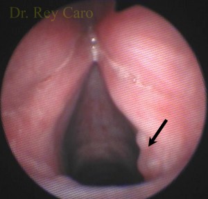 Post operatorio de 5 meses. La flecha muestra un pequeño granuloma de cicatrización. Mild granuloma due to incomplete healing after 5 month of surgery (arrow)