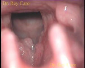 Papilomatosis severa en un paciente difícil de intubar. Severe papillomatosis in a patient with difficult intubation