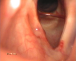 Formación de fibrina post operatoria en comisura anterior. Post surgery fibrin web in anterior commissure