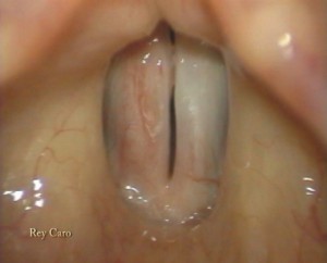 Imagen estroboscópica de la laringe. 1 año post operatorio. Vocal fold stroboscopy 1 year after surgery