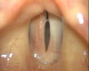 Imagen estroboscópica de la laringe. 1 año post operatorio. Vocal fold stroboscopy 1 year after surgery