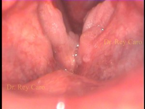 Papilomatosis de cuerdas vocales, comisura anterior y ventriculo izquierdo. papillomatosis of both vocal cords and anterior commissure. 