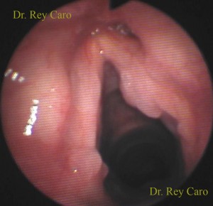 Papilomatosis de cuerda vocal y ventrículo derechos y apófisis vocal de cuerda vocal izquierda. The laryngeal areas involved with papillomas in this patient are right vocal cord and ventricle, and left vocal cord process.