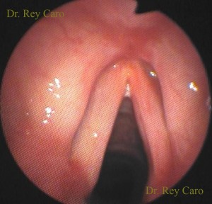 6 meses post operatorio. Todas las áreas anatómicas de laringe están libres de papilomas. 6 month after surgery. All anatomical areas of the larynx are free of papillomas