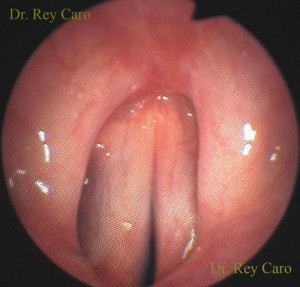 6 meses post operatorios. Endoscopía de acercamiento. 6 month after surgery. Closer endoscopic view. It can be seen glottis and supraglottis free of papillomas