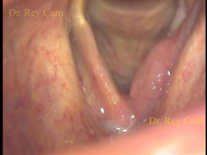 Papilomatosis de cuerda vocal y ventriculo izquierdos y comisura anterior. Right ventricle, vocal cord and commissure RRP.