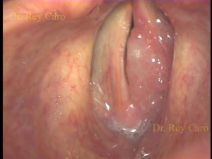 En la fonación se observa compromiso extenso del ventriculo izquierdo. It can be seen a severe involvement of the left ventricle