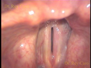 Seis meses post operatorios. Apariencia casi normal de la cuerda vocal izquierda. Almost normal appearance of the left vocal cord