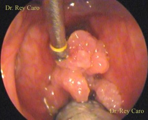 Vista intraoperatoria con endoscopía rígida convencional. Puede dimensionarse la severidad de la afección. Conventional intraoperative endoscopic view. 