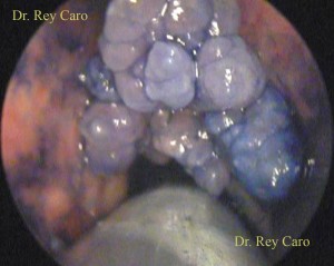 Cromoendoscopía intraoperatoria con Indigo Carmín. Indigo Camine intraoperatory chromoendoscopy.