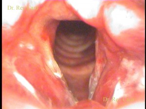 21días post operatorio. se observa moderada cantidad de fibrina cicatrizal sin complicaciones . 21 days after surgery. No complications and no harm to the organ (synechia) can be seen.