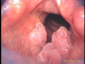 Severa papilomatosis glótica y supraglótica con moderado compromiso respiratorio. Life-threatening glottic and supraglottic papillomatosis with moderate to severe breathing difficulties.